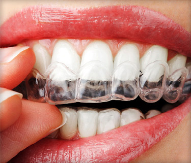 Teeth Whitening standard system