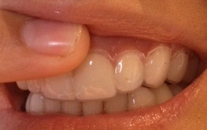 Teeth whitening